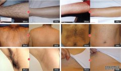 OPT脫毛儀器的效果有多好,不試你不會知道！