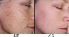 超皮秒價(jià)格，超皮秒廠家哪個(gè)比較好？