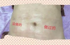 去妊娠紋機(jī)器多少錢(qián)一臺(tái)？美容院去除妊娠紋機(jī)器設(shè)備價(jià)格